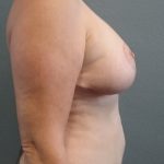 Mastopexy (Breast Lift) Before & After Patient #817