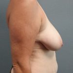 Mastopexy (Breast Lift) Before & After Patient #817