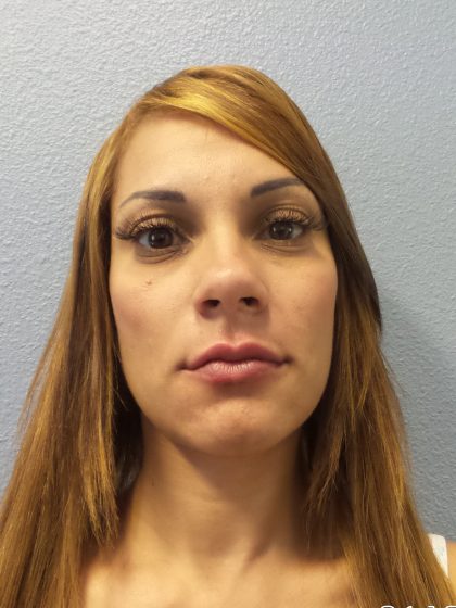 Filler Before & After Patient #2246