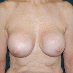 Breast Augmentation Revision (Breast Enlargement Repair) Before & After Patient #656