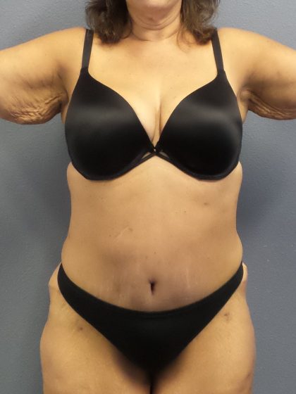 Abdominoplasty Before & After Patient #2113