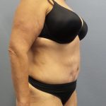 Abdominoplasty Before & After Patient #2113