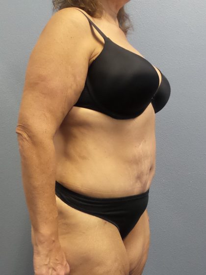 Abdominoplasty Before & After Patient #2113