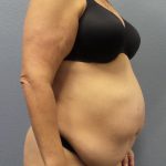 Abdominoplasty Before & After Patient #2113