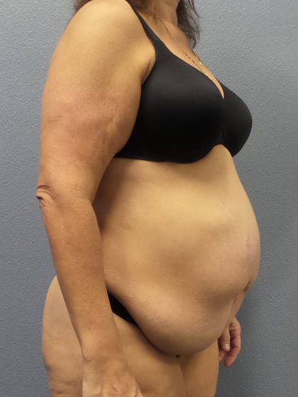 Abdominoplasty Before & After Patient #2113