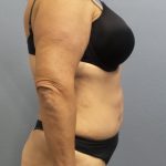 Abdominoplasty Before & After Patient #2113