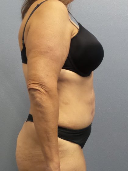 Abdominoplasty Before & After Patient #2113