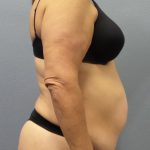 Abdominoplasty Before & After Patient #2113