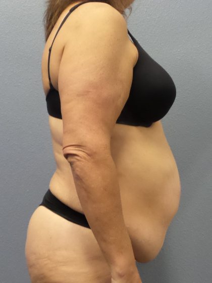 Abdominoplasty Before & After Patient #2113