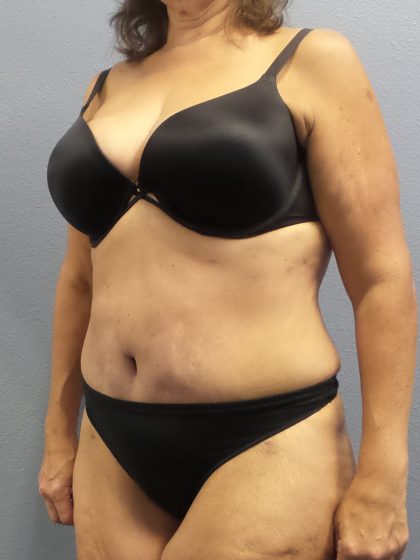 Abdominoplasty Before & After Patient #2113
