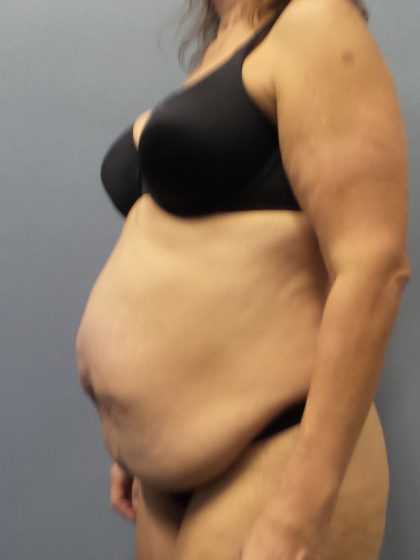 Abdominoplasty Before & After Patient #2113