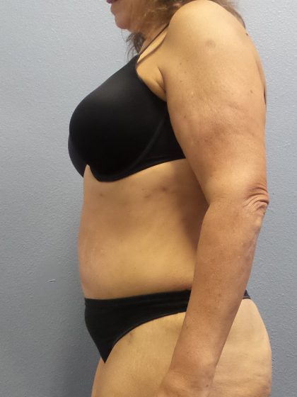 Abdominoplasty Before & After Patient #2113