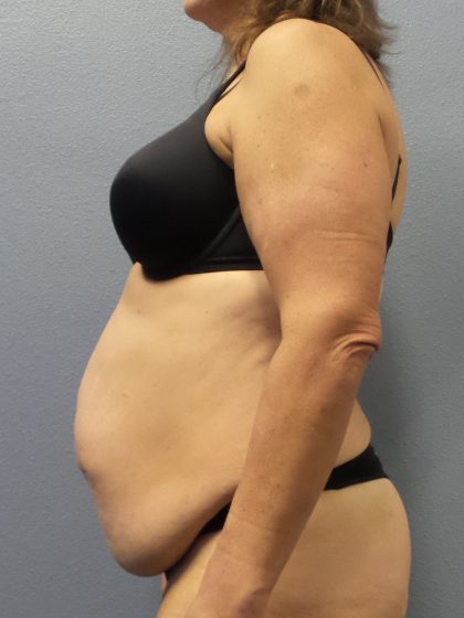 Abdominoplasty Before & After Patient #2113