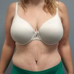 Abdominoplasty Before & After Patient #2120