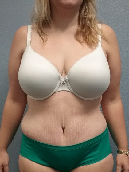 Abdominoplasty Before & After Patient #2120