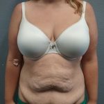 Abdominoplasty Before & After Patient #2120