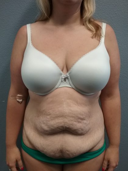 Abdominoplasty Before & After Patient #2120