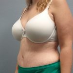 Abdominoplasty Before & After Patient #2120