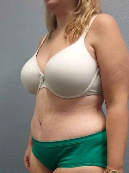 Abdominoplasty Before & After Patient #2120