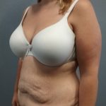 Abdominoplasty Before & After Patient #2120