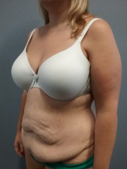 Abdominoplasty Before & After Patient #2120