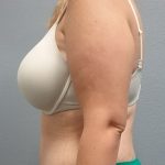 Abdominoplasty Before & After Patient #2120