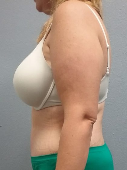 Abdominoplasty Before & After Patient #2120