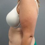 Abdominoplasty Before & After Patient #2120