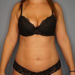Liposuction Female Before & After Patient #1117