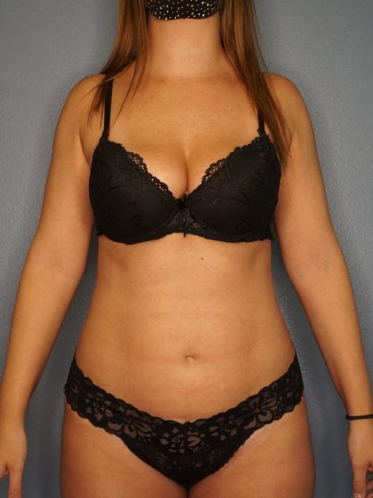 Liposuction Female Before & After Patient #1117