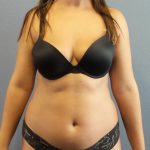Liposuction Female Before & After Patient #1117