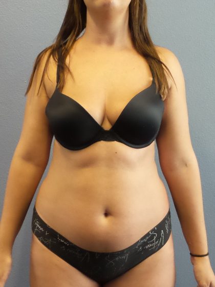 Liposuction Female Before & After Patient #1117