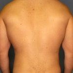 Male Liposuction Before & After Patient #1893