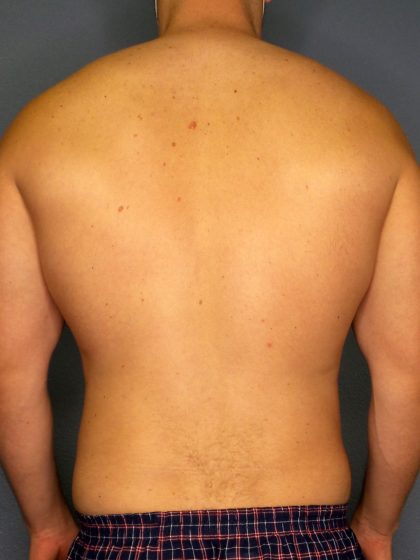 Male Liposuction Before & After Patient #1893