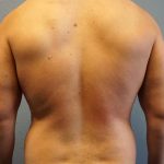Male Liposuction Before & After Patient #1893