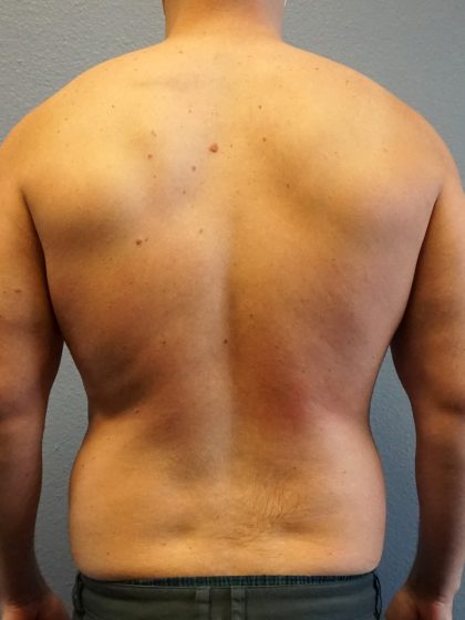 Male Liposuction Before & After Patient #1893