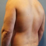Male Liposuction Before & After Patient #1893