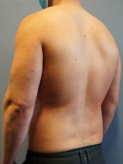 Male Liposuction Before & After Patient #1893