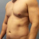Male Liposuction Before & After Patient #1893