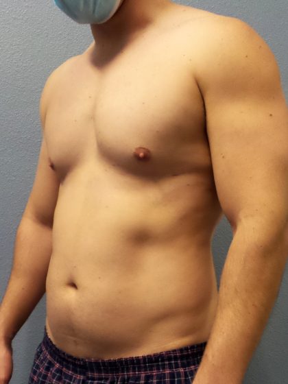 Male Liposuction Before & After Patient #1893