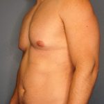 Male Liposuction Before & After Patient #1893