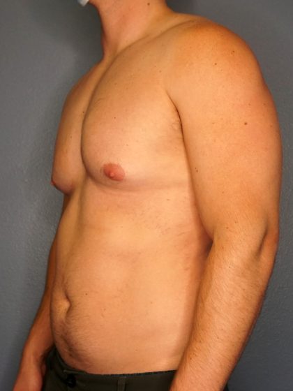 Male Liposuction Before & After Patient #1893