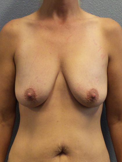 Breast Lift with Implant (Augmentation Mastopexy) Before & After Patient #1045