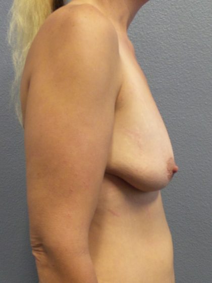 Breast Lift with Implant (Augmentation Mastopexy) Before & After Patient #1045
