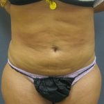 Liposuction Female Before & After Patient #1177