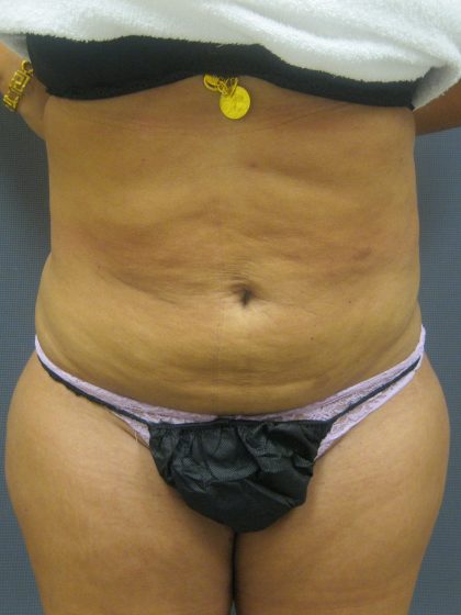 Liposuction Female Before & After Patient #1177