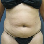 Liposuction Female Before & After Patient #1177