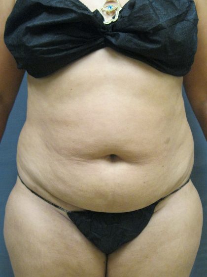 Liposuction Female Before & After Patient #1177