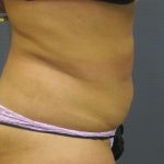 Liposuction Female Before & After Patient #1177