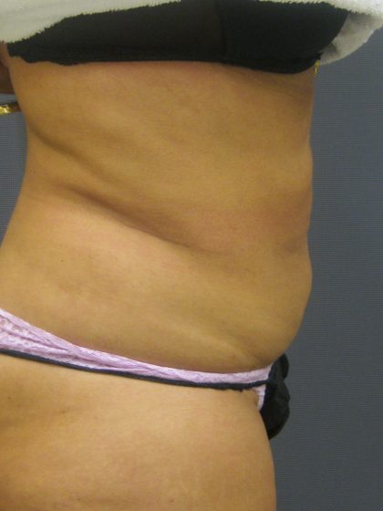 Liposuction Female Before & After Patient #1177